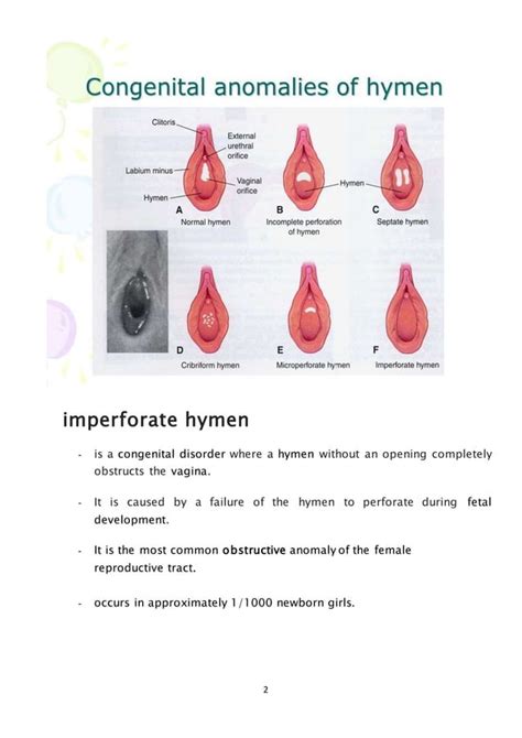 hymen pictures|Hymen